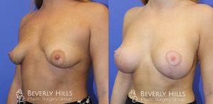 Tuberous Breast Correction 2 Left 6-1
