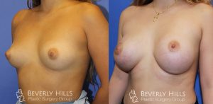 Breast Augmentation Left Oblique View