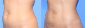 Beverly Hills BodyTite Minimally Invasive Liposuction and Skin Tightening