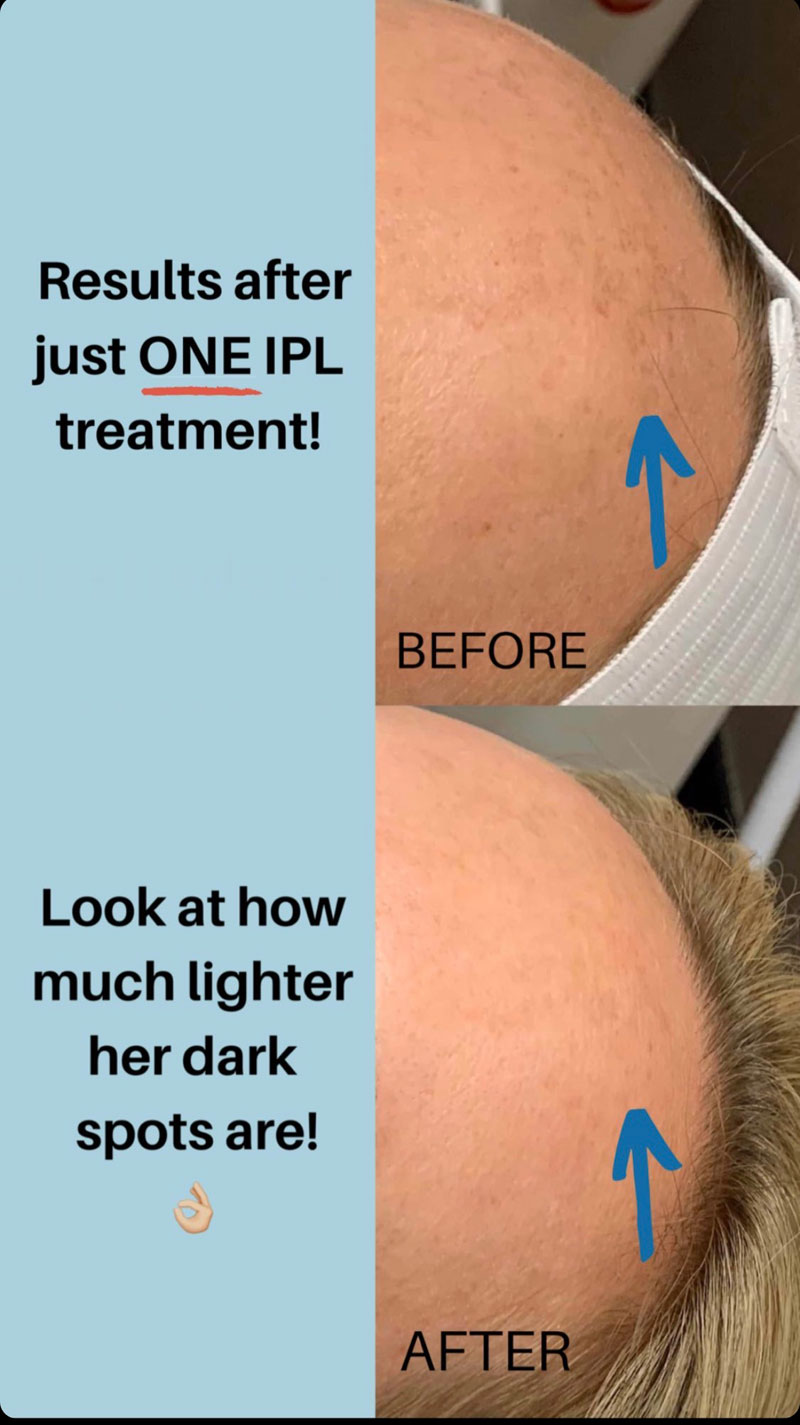 IPL Treatment Results